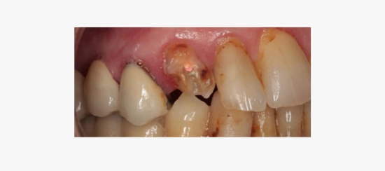 destruccion dental severa (2)
