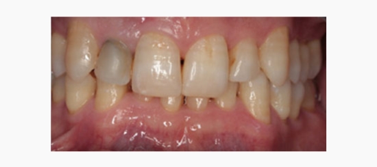 mejora estetica dientes aislados (1)