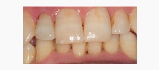 mejora estetica dientes aislados (2)