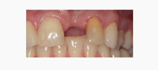 reposicion dental (1)