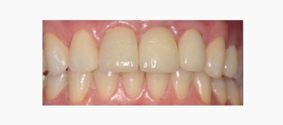 reposicion dental (2)